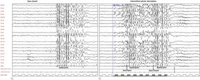 Case report: A relevant misdiagnosis: Photosensitive epilepsy mimicking a blinking tic
